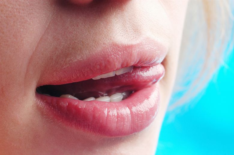 Durch oralverkehr mundsoor 10 Natürliche