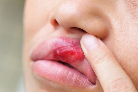 Bläschen im Mund