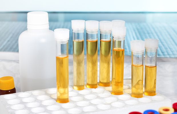 Urinprobe zur Diagnose einer Nierenbeckenentzündung