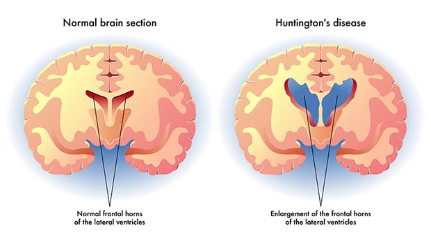 Chorea Huntington Krankheit Chorea Huntington Krankheit