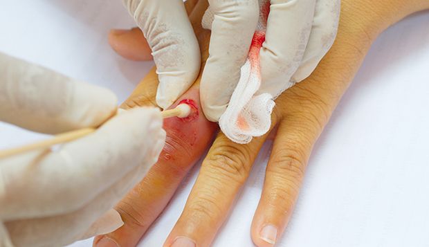 Abszess am Finger Abszess am Finger