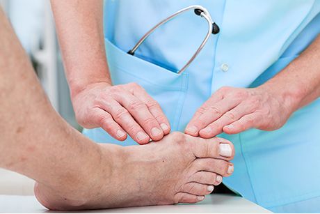 Hallux valgus
