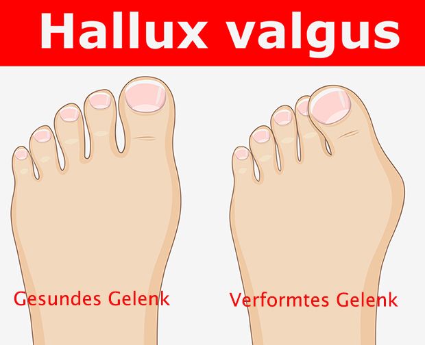 Bei Hallux valgus schiebt sich der Großzeh unter oder über den zweiten Zeh Bei Hallux valgus schiebt sich der Großzeh unter oder über den zweiten Zeh