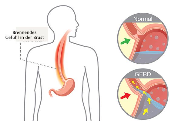 Eine Refluxösophagitis geht mit einer Entzündung der Speiseröhre einher.