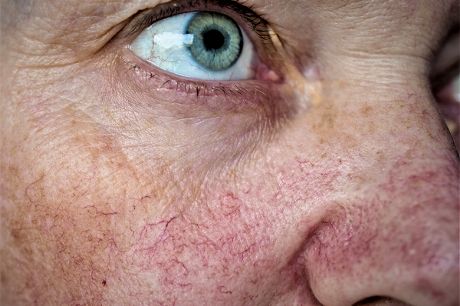 Rosacea