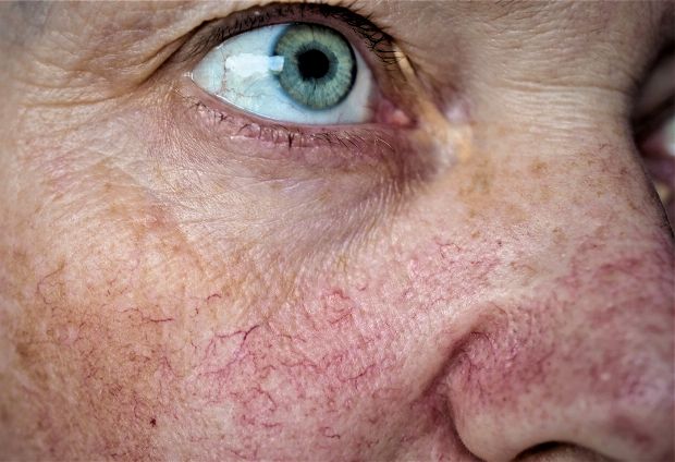 Rosacea