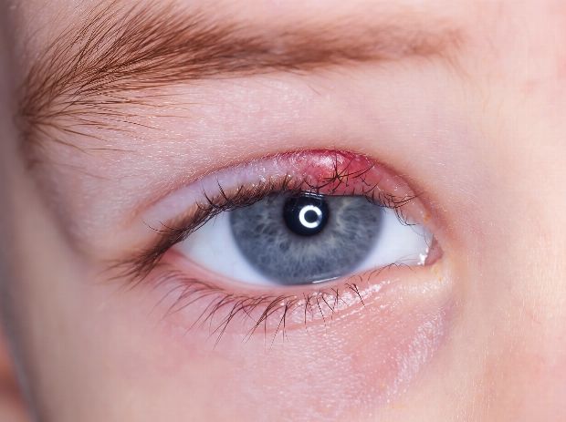 Hagelkorn am Auge