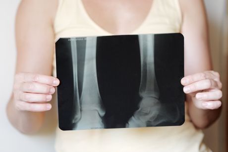 Osteoporose