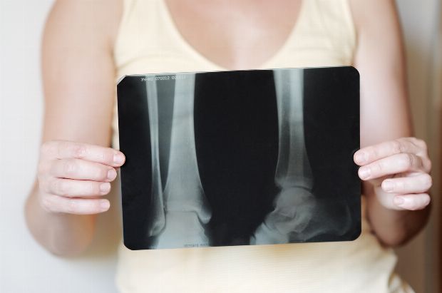 Röntgen Osteoporse