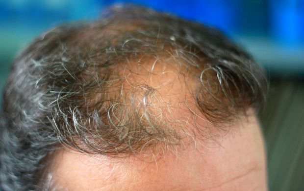schütteres Haar schütteres Haar