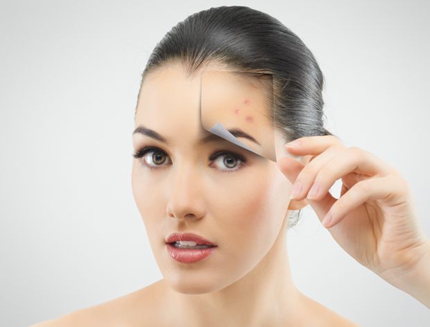 Fruchtsäure Peeling bei Akne Fruchtsäure Peeling bei Akne