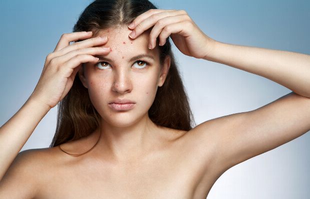 Mädchen leidet unter Pickeln im Gesicht Mädchen leidet unter Pickeln im Gesicht