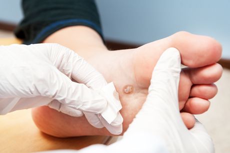 Dornwarzen entfernen