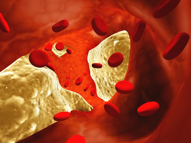 Arteriosklerose