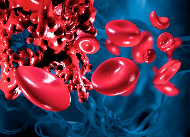 Blutgerinnsel Thrombose