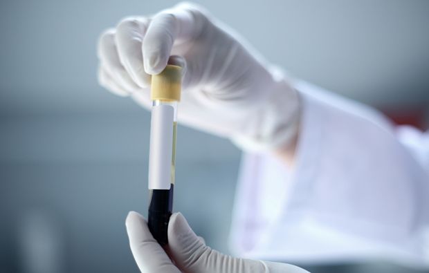 Diagnose Pfeiffersches Drüsenfieber durch Blutuntersuchung