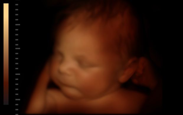 Baby Ultraschall