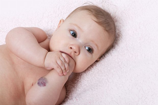 Baby mit Blutschwamm Baby mit Blutschwamm