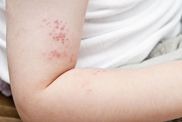 Herpes Zoster Herpes Zoster