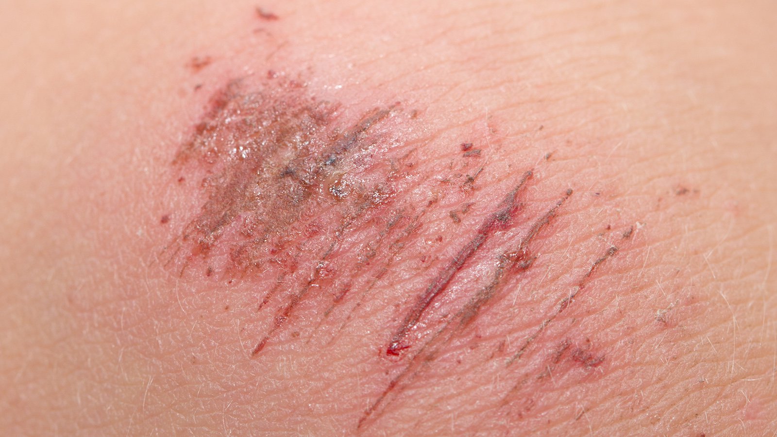 Sachverstand Ständig breit schürfwunde knie pflaster Mais Meditation Trauben