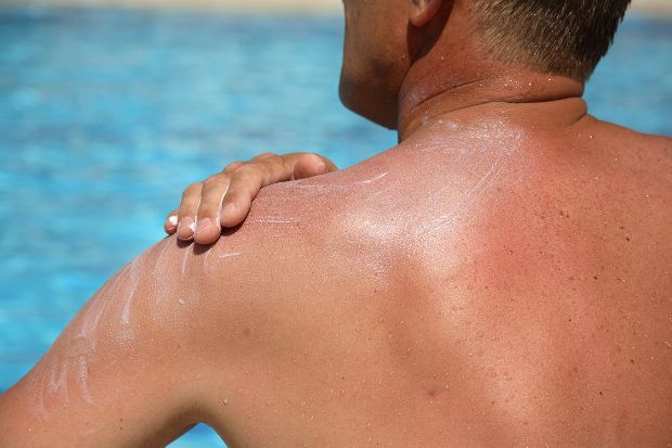 Sonnenbrand Sonnenbrand