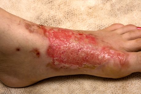 Verbrennungen und Verbrühungen