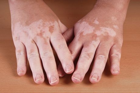 Vitiligo