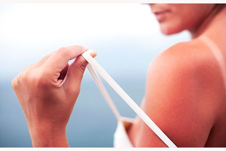 Erste Hilfe bei Sonnenbrand