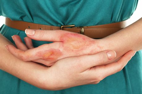 Erste Hilfe bei Verbrennungen